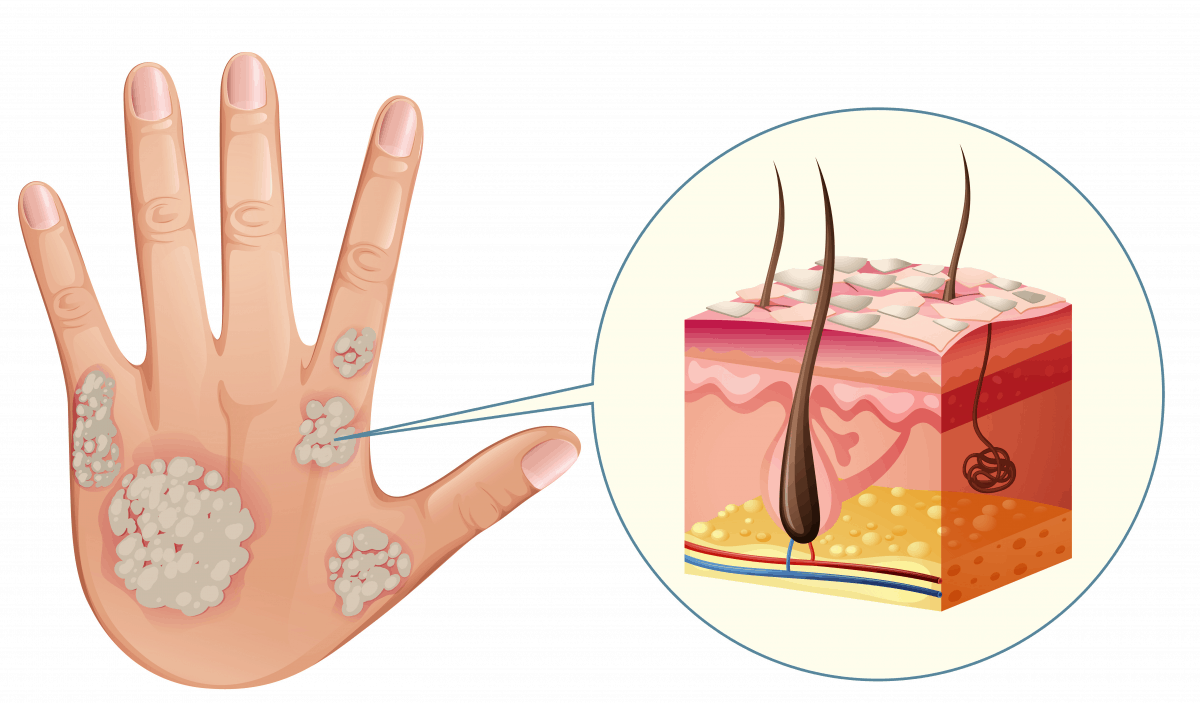 牛皮癬皮膚癢又乾 乾癬的原因症狀與治療方法 Hello醫師