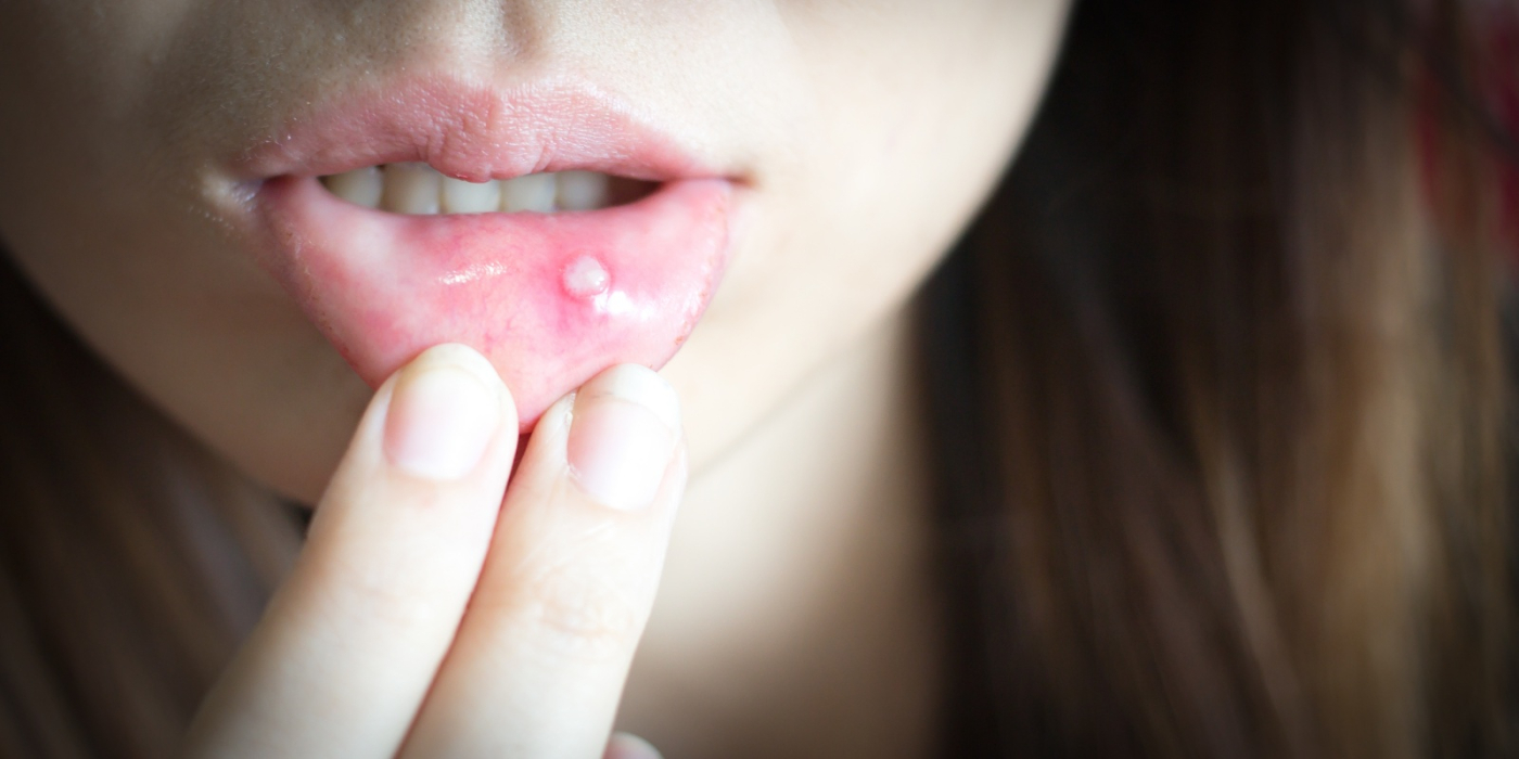 嘴巴破洞怎麼辦?嘴破吃什麼?口腔潰瘍3招快速治療