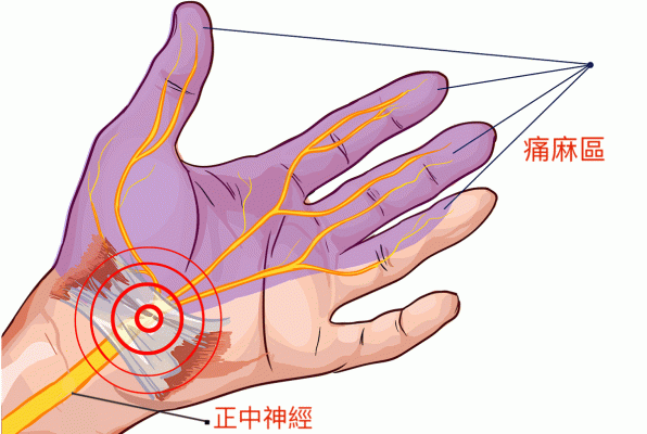 腕隧道症候群該看哪科 症狀 原因 治療與檢查 Hello醫師