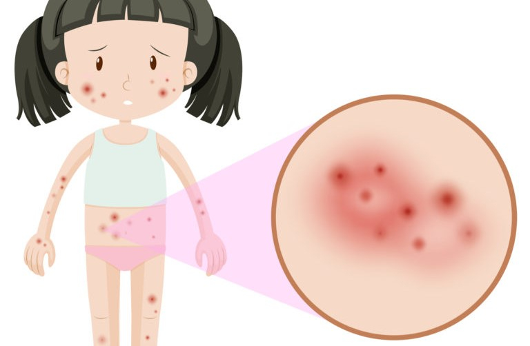 皮膚炎、濕疹、乾癬？差別在哪一次弄懂