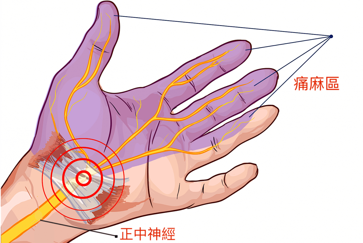 腕隧道症候群該看哪科？症狀、原因、治療與檢查