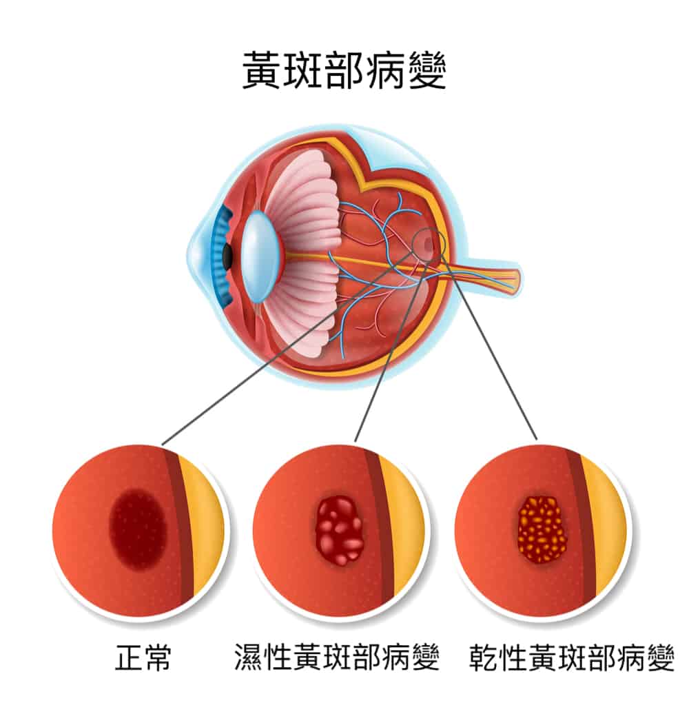 黃斑部病變：症狀、原因、治療、改善方式
