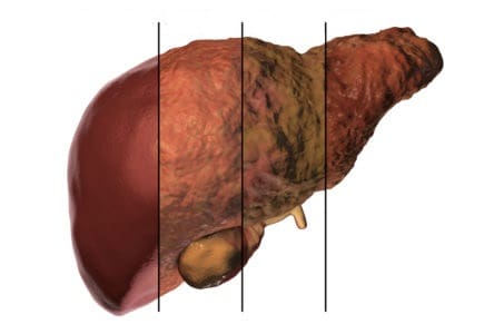 肝纖維化與肝硬化~弄清楚哪裡不同