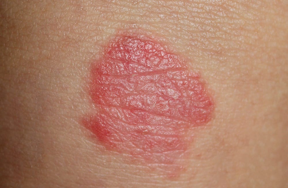 牛皮癬皮膚癢又乾 乾癬的原因症狀與治療方法 Hello醫師