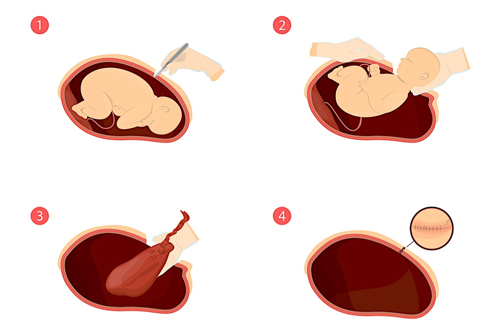 自然產、剖腹產好處壞處有哪些？優缺點一次搞清楚