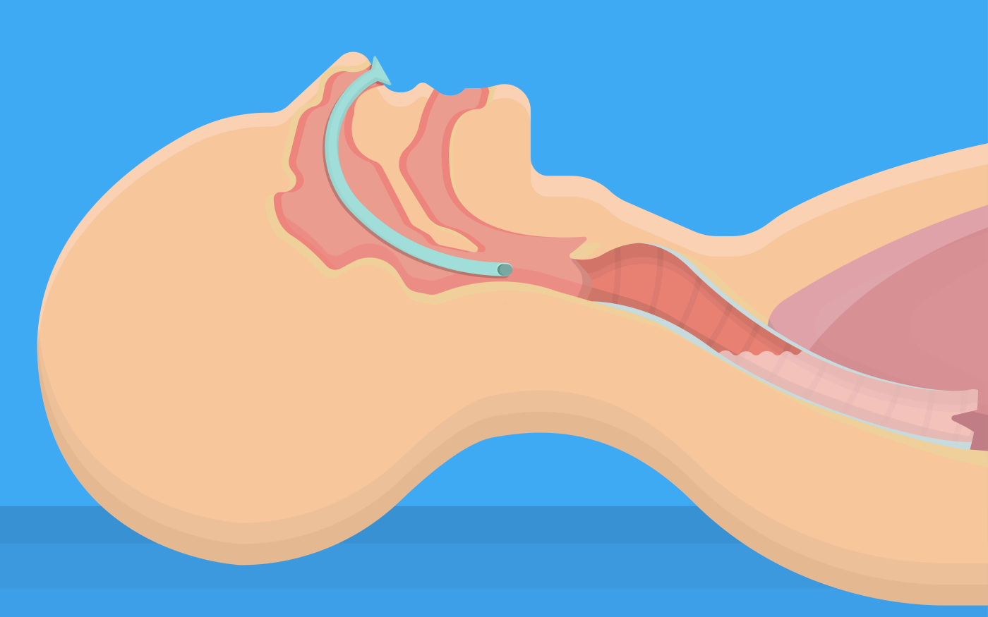 鼻咽炎：原因、症狀、診斷、治療