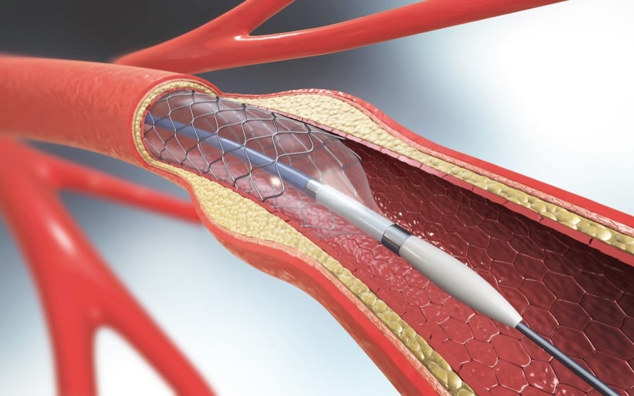 冠狀動脈繞道手術｜手術風險、過程、術前準備、術後傷口照護須知