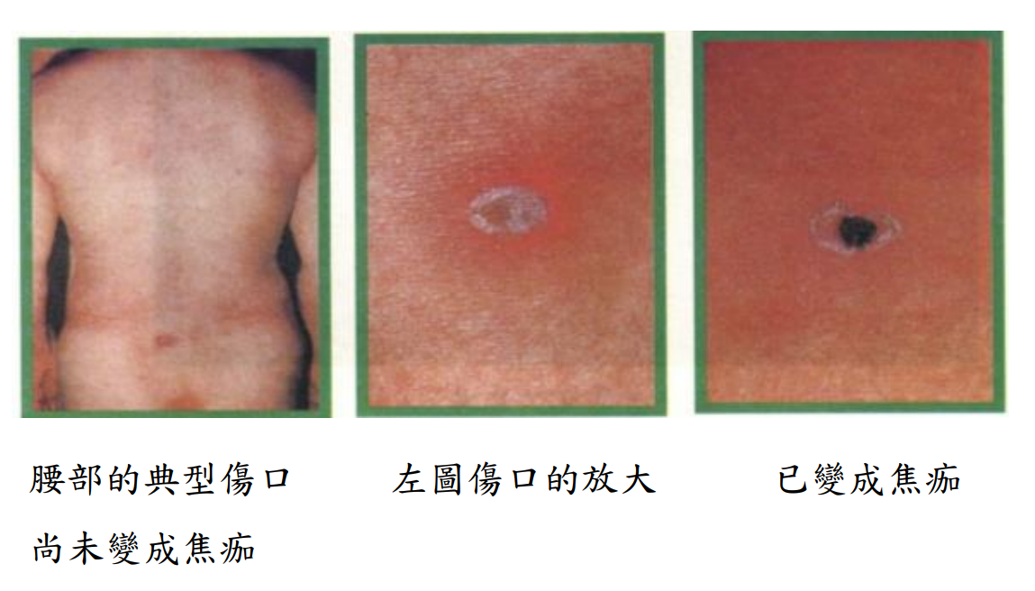 恙蟲病症狀（焦痂 Eschar）