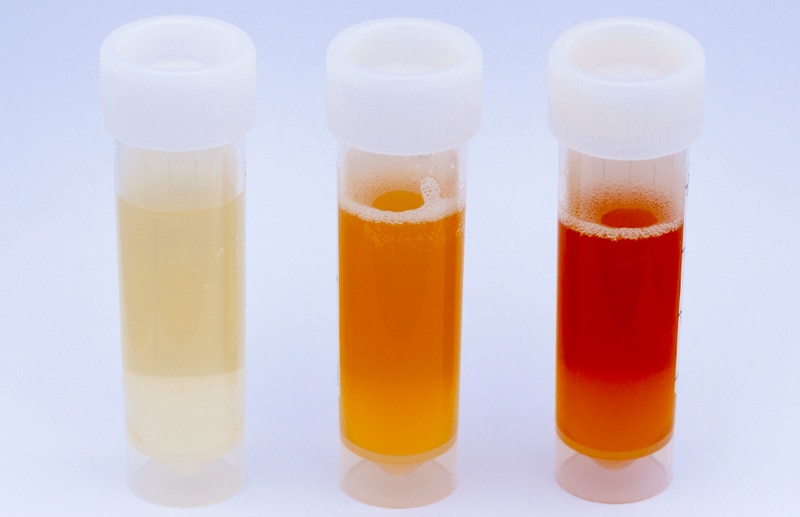 尿尿完看一下！10種尿液顏色狀況看健康