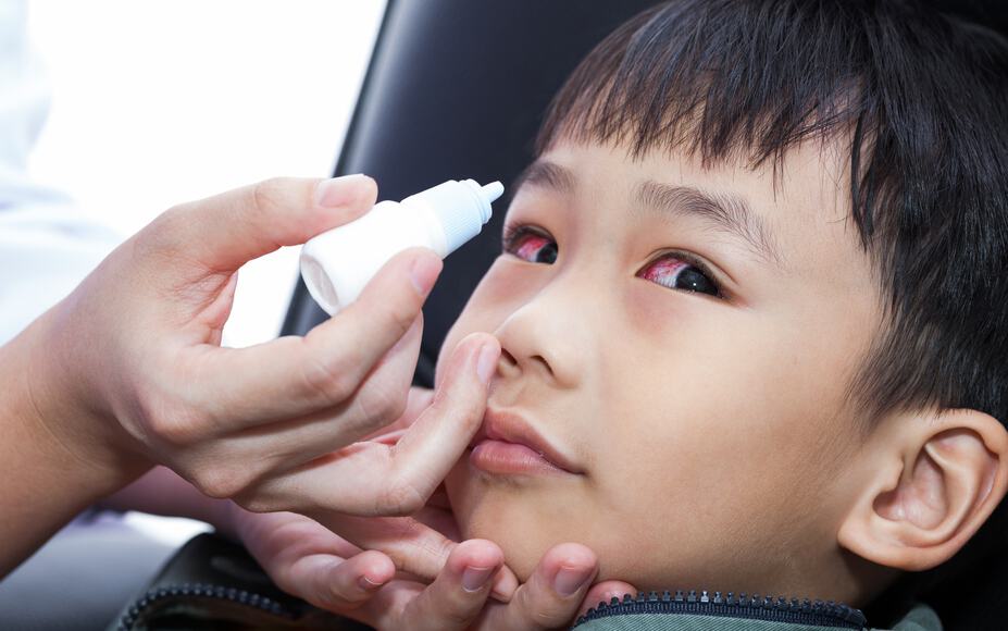 結膜炎症狀、原因解析！結膜炎多久會自己好？會傳染嗎？