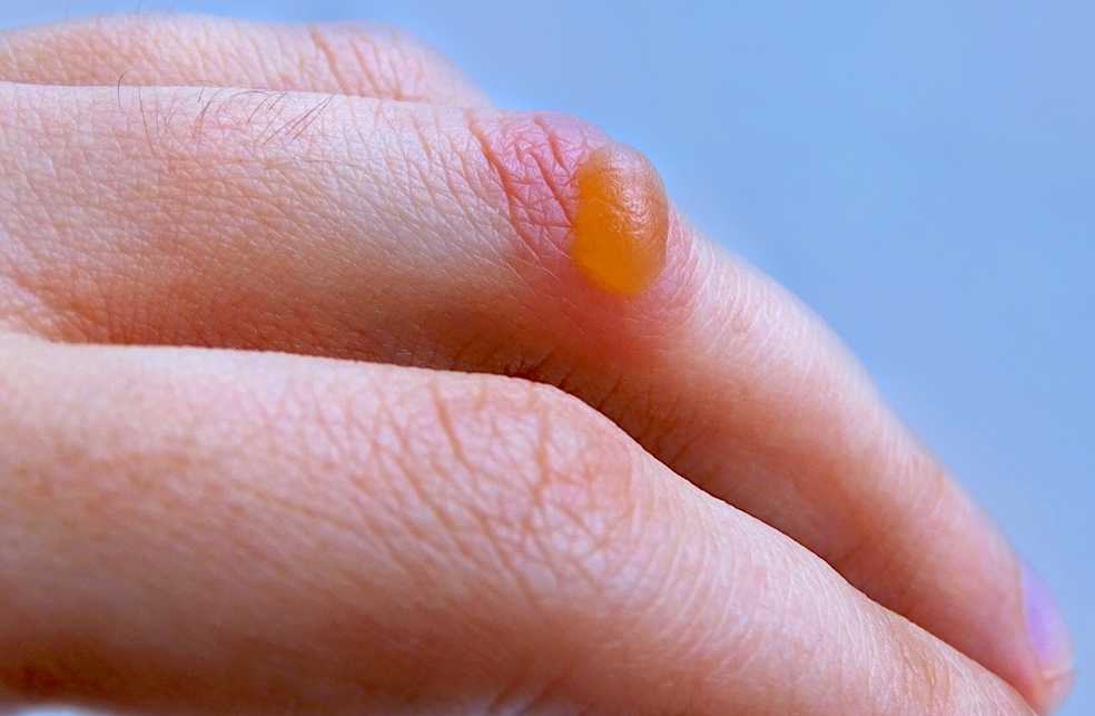 什麼狀況該刺破水泡？6步驟安全搞定