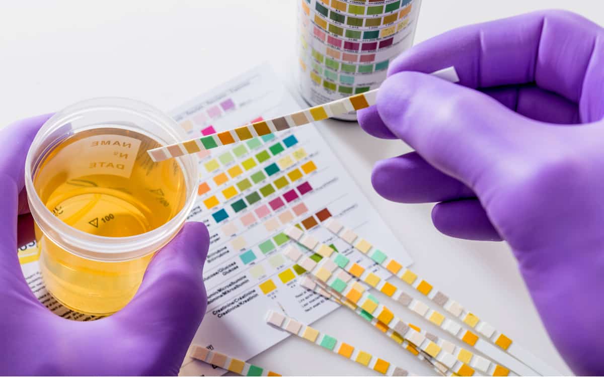 驗尿：原因、流程、前後須知、尿液檢查結果