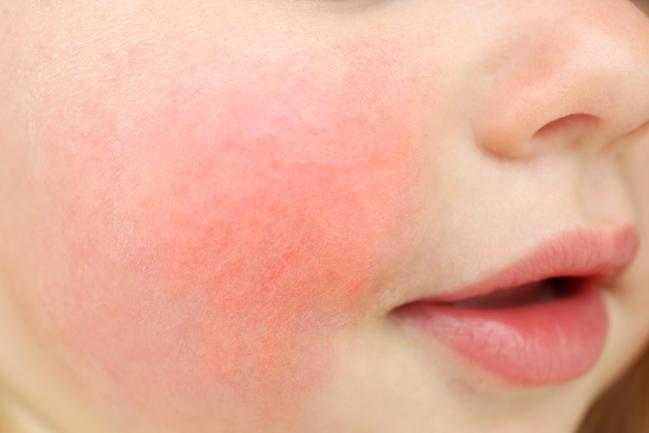 蘋果病是什麼？傳染性紅斑症的症狀、潛伏期、預防治療詳解