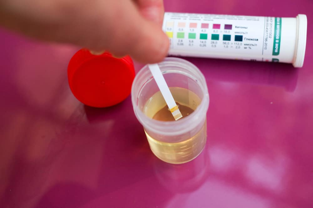 糖尿病患检查尿酮