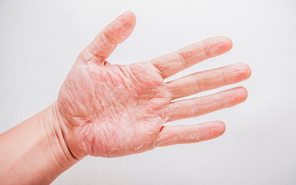 手部持續發癢脫皮 小心富貴手找上門 Hello 醫師