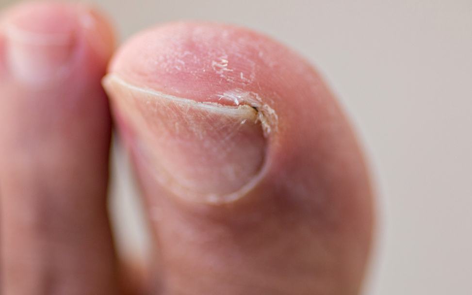 穿鞋痛得受不了 可能是嵌甲惹的禍 Hello 醫師