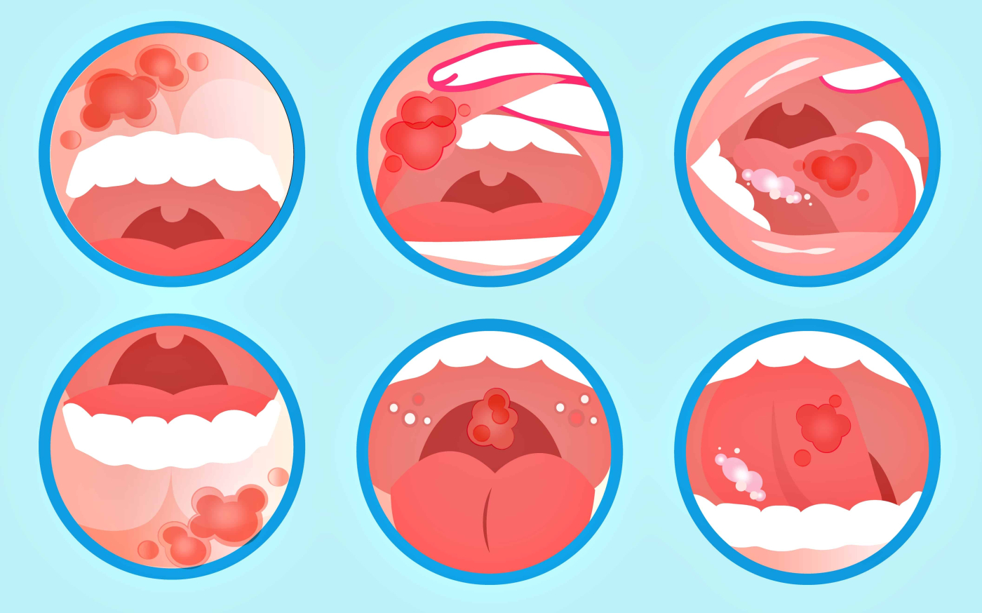 口腔紅白斑：症狀、原因、診斷、治療