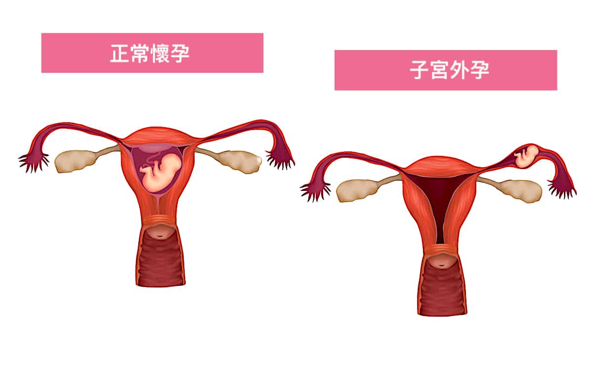 肚子痛竟是子宮外孕！了解子宮外孕診斷與治療
