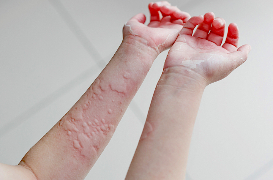 蕁麻疹5原因！蕁麻疹症狀、飲食、治療、止癢緊急處理一次懂