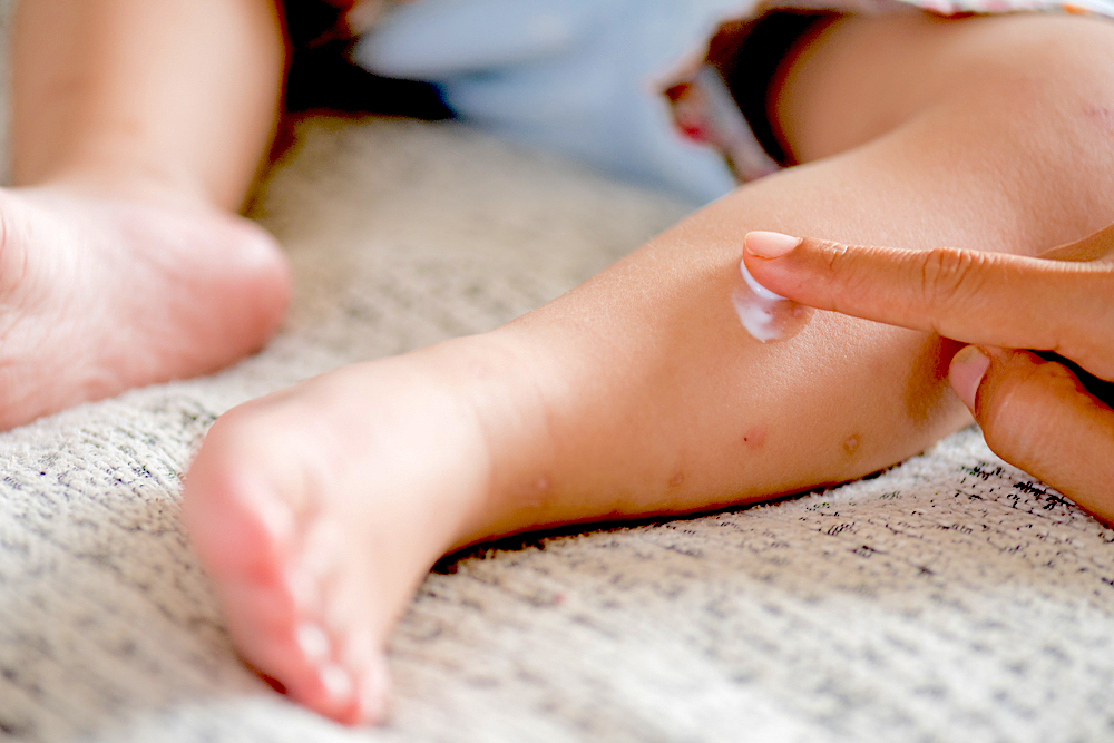 手、腳長水泡怎麼辦？5招預防及安全處理水泡