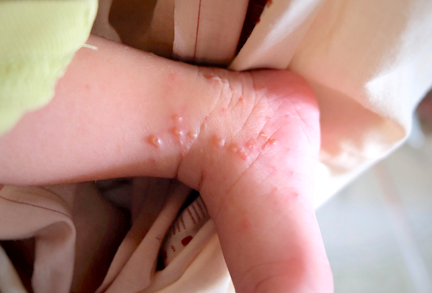 汗皰疹6原因！手腳癢、長水泡注意！汗皰疹藥膏、治療解說