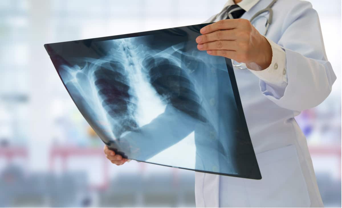肺結核症狀？會傳染嗎？會自己好嗎？肺結核診斷、治療詳解