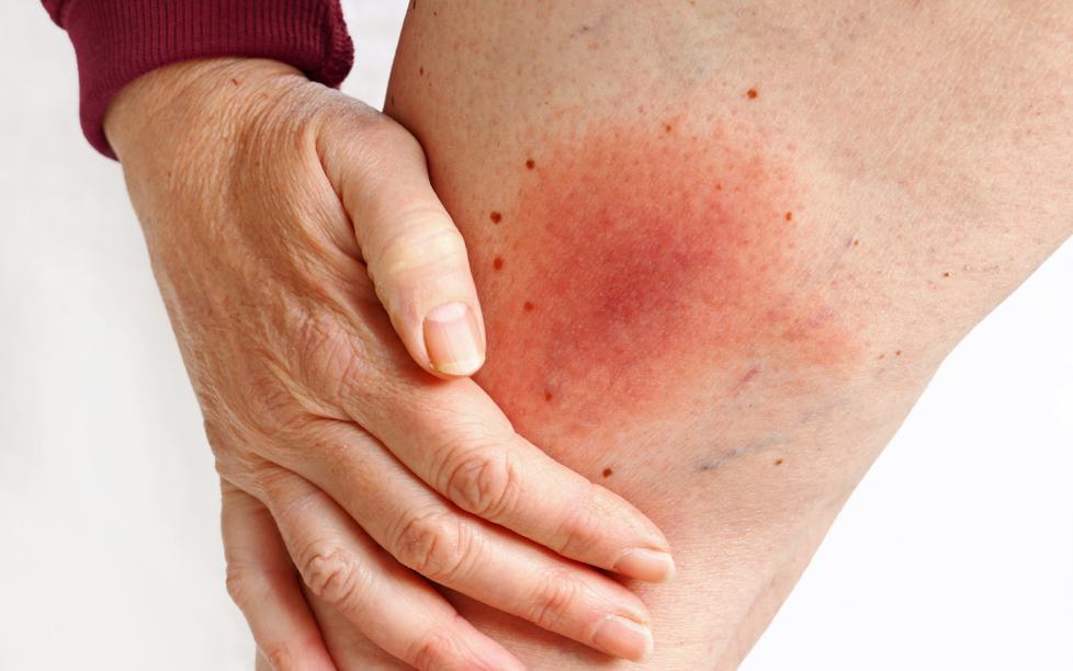 萊姆病是什麼？萊姆病原因、症狀、診斷、治療解析