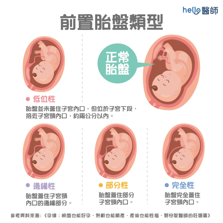生產要自然還是剖腹?了解差異,聰明做選擇 生產要自然還是剖腹?了解差異,聰明做選擇