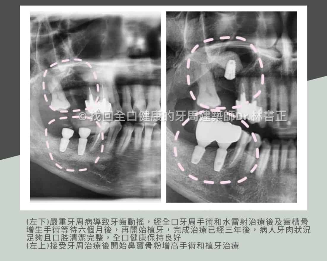 补骨植牙治疗后