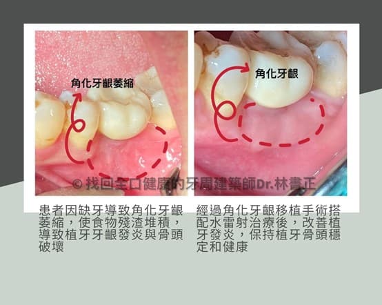 角化牙龈