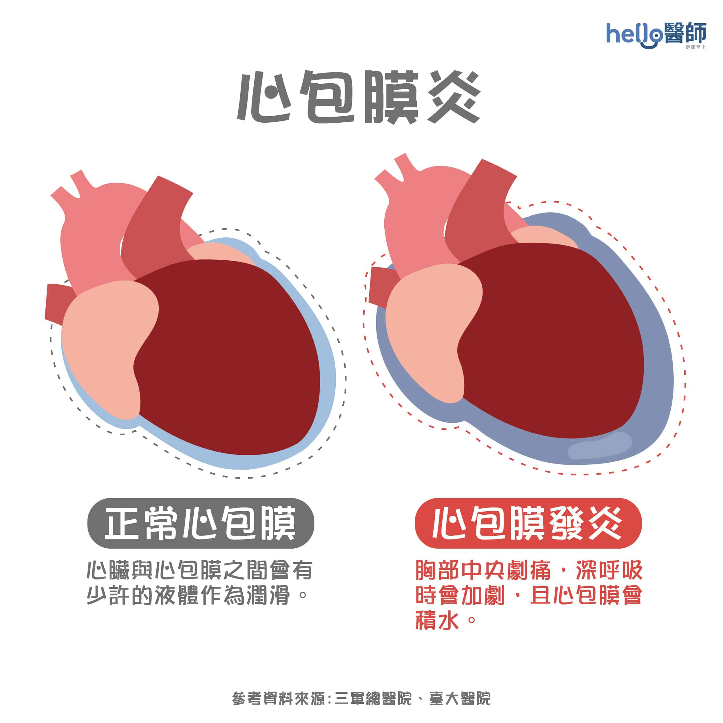 心包膜炎原因?急性、慢性心包炎症狀?心包膜炎治療解析