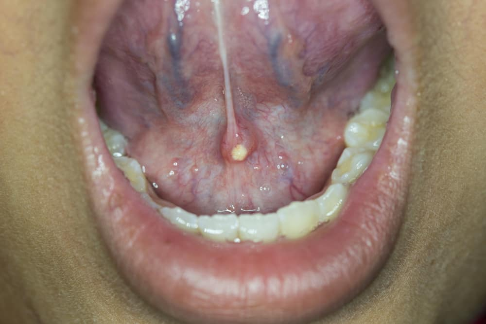 唾液腺结石