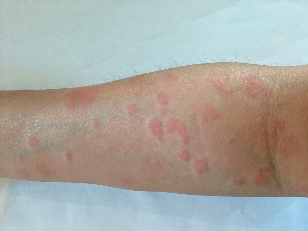  红斑性狼疮症状