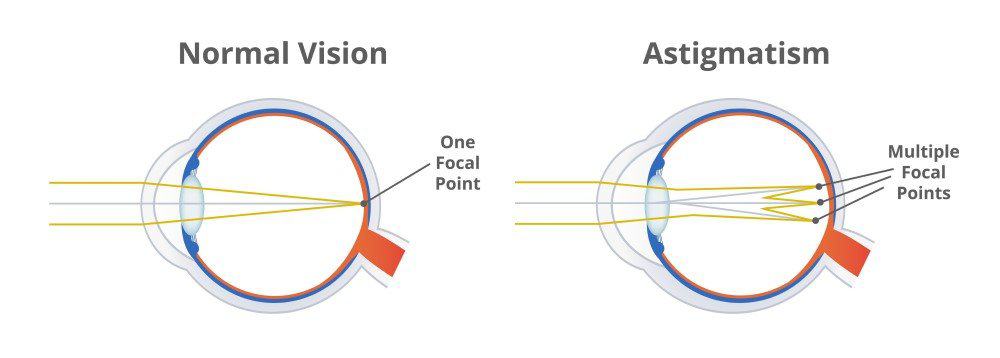 小孩看电视会散光？解说儿童散光原因、症状！及早矫正不弱视