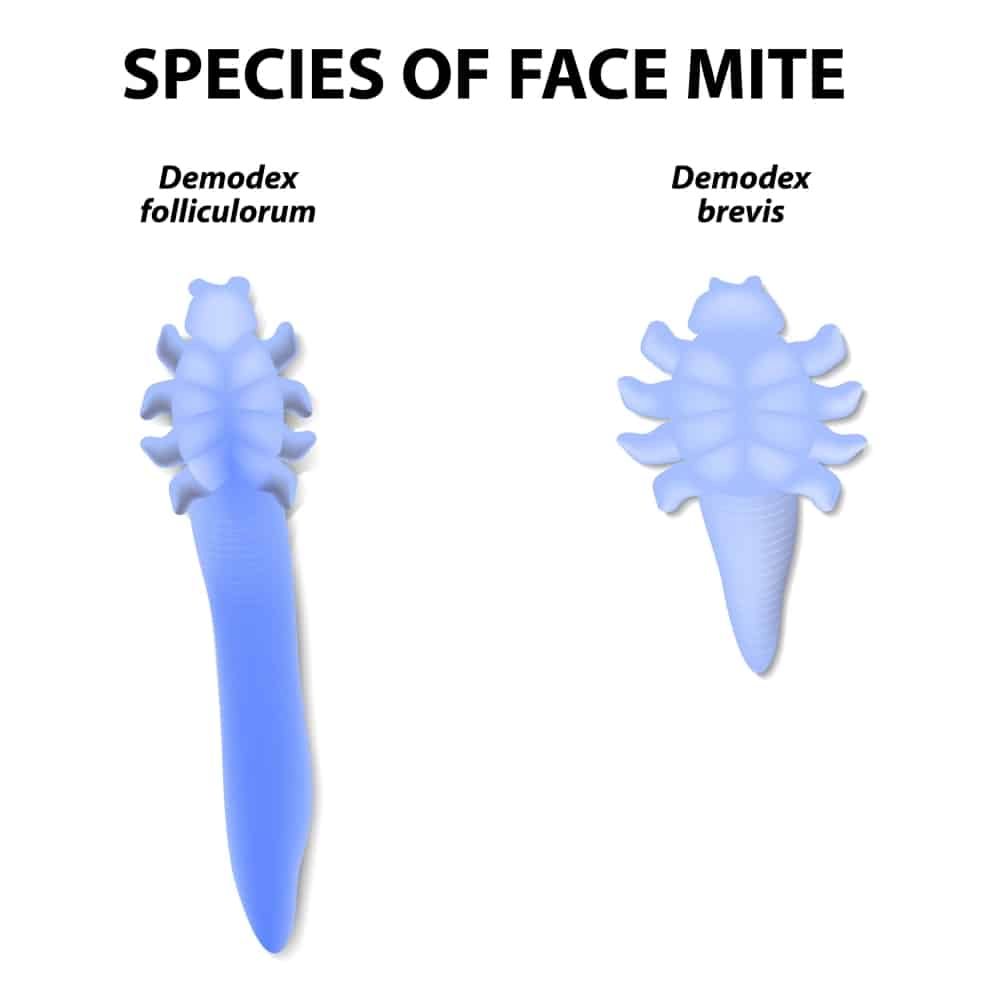 脸上有蠕形螨虫怎么办?蠕形螨虫的症状、原因、治疗药膏公开
