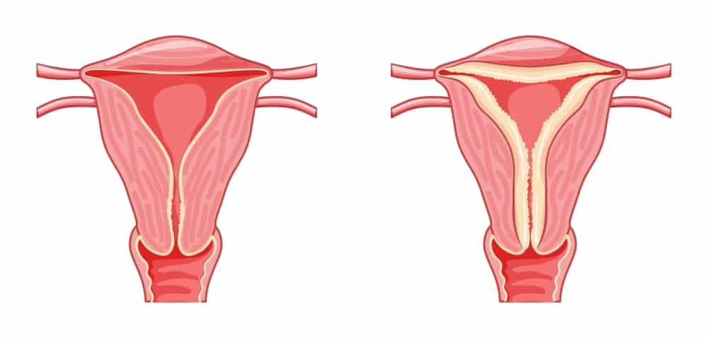 子宫内膜增厚就是癌症?子宫内膜增生原因、症状、诊断及治疗一览