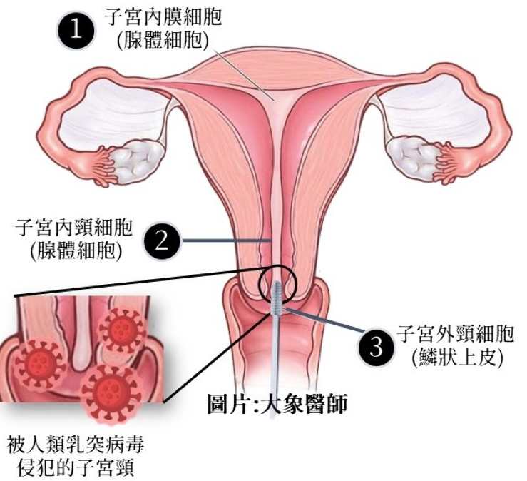 子宫抹片检查前必看！6大注意事项、报告怎么看？异常原因一次看
