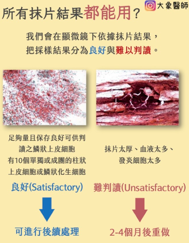 子宫抹片检查前必看！6大注意事项、报告怎么看？异常原因一次看
