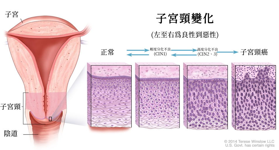 子宫抹片检查前必看！6大注意事项、报告怎么看？异常原因一次看