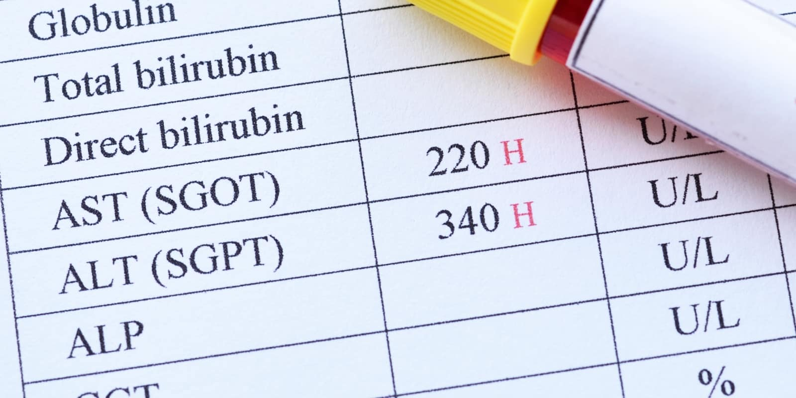 肝指數過高怎麼降？肝指數正常值標準、過高原因、治療及