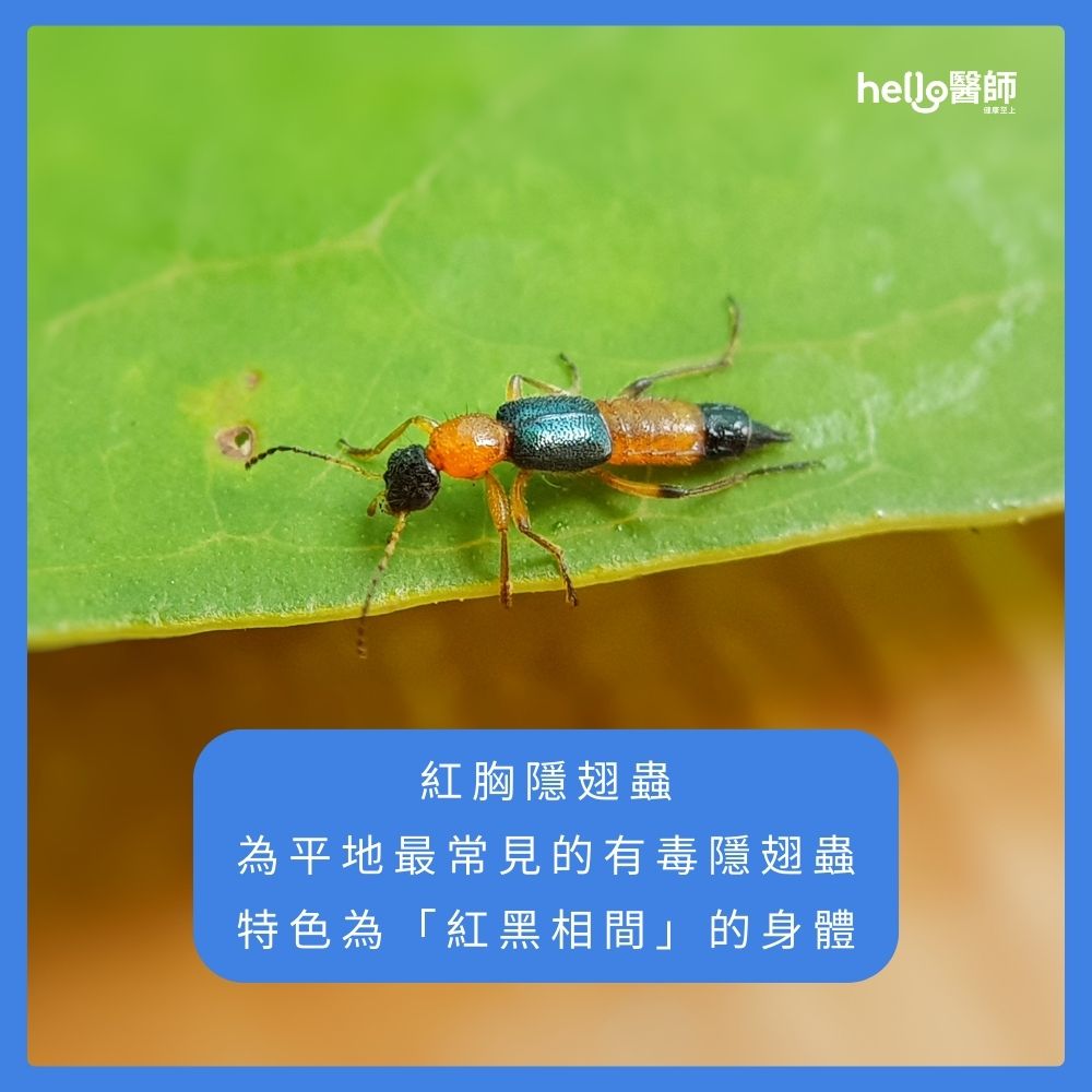 紅胸隱翅蟲 為平地最常見的有毒隱翅蟲