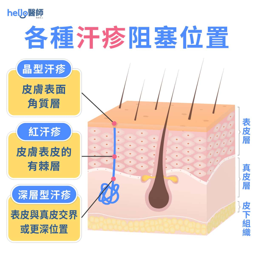 汗疹=痱子!長汗疹原因?會自己好嗎?藥膏、消除方法一次看