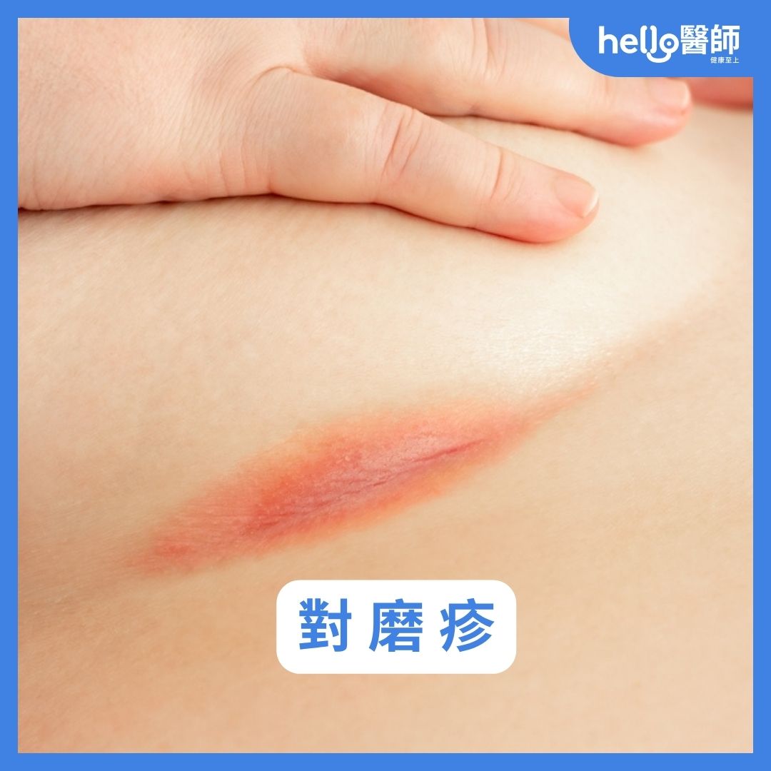 紅疹種類有哪些?皮疹、丘疹差異?8種皮膚紅疹原因與照片