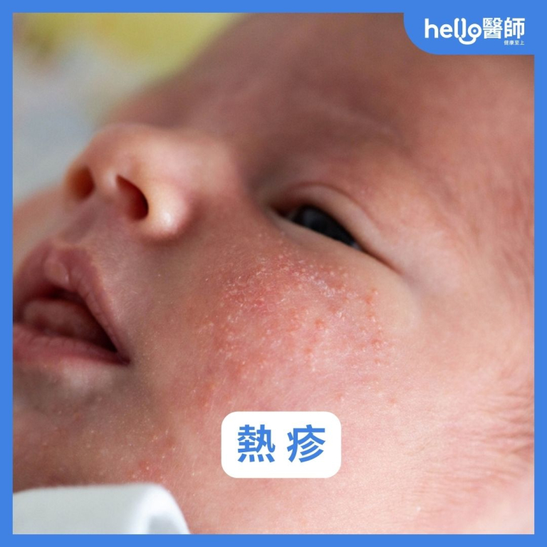 紅疹種類有哪些?皮疹、丘疹差異?8種皮膚紅疹原因與照片