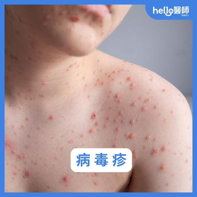 紅疹種類有哪些？皮疹、丘疹差異？8種皮膚紅疹原因與照片