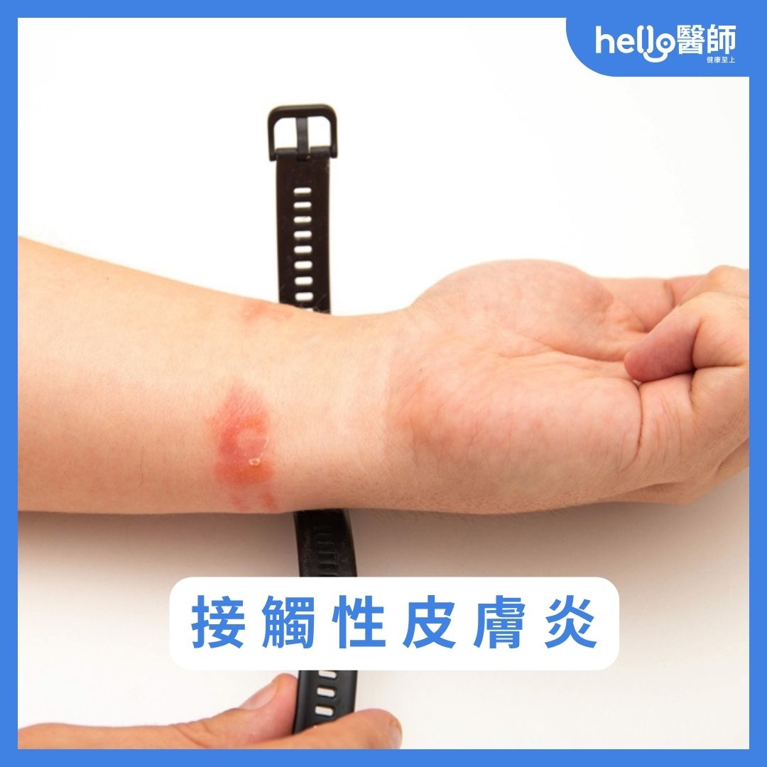 接觸性皮膚炎症狀照片