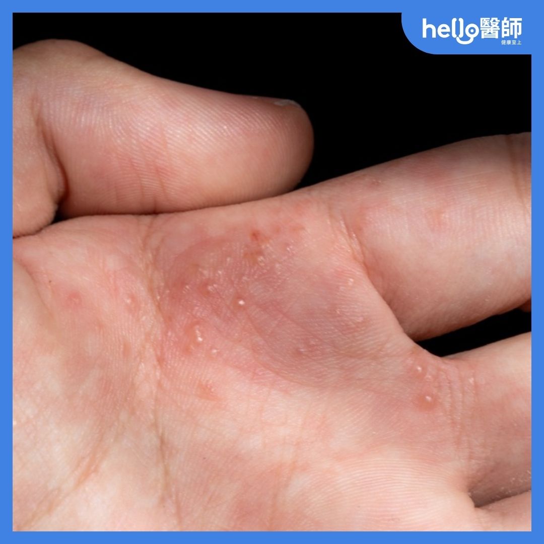 汗皰疹發作後會出現密集小水泡