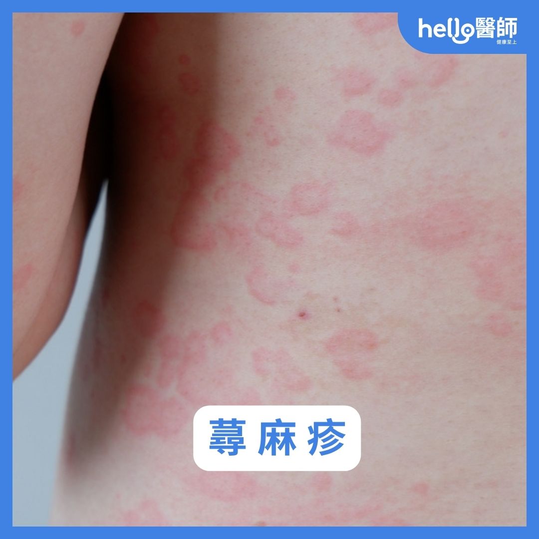 蕁麻疹症狀照片