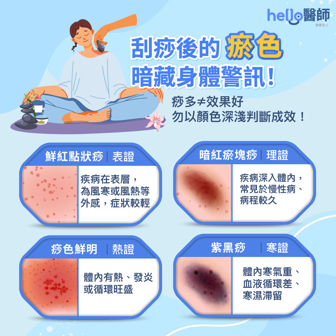 刮痧原理、好處？刮痧出痧顏色、位置、禁忌、方法一次答