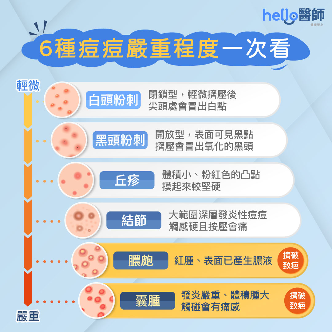 額頭長痘痘原因、位置解析！額頭痘痘怎麼消？痘痘改善4方法
